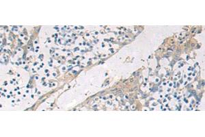 Immunohistochemistry of paraffin-embedded Human tonsil tissue using GBA Polyclonal Antibody at dilution of 1:55(x200)