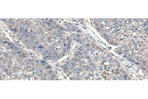 Immunohistochemistry of paraffin-embedded Human liver cancer tissue using XDH Polyclonal Antibody at dilution of 1:85(x200)