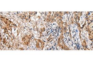Immunohistochemistry of paraffin-embedded Human lung cancer tissue using LYPD4 Polyclonal Antibody at dilution of 1:25(x200)