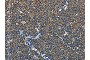 The image on the left is immunohistochemistry of paraffin-embedded Human lymphoma tissue using ABIN7131012(SEPT9 Antibody) at dilution 1/15, on the right is treated with fusion protein.