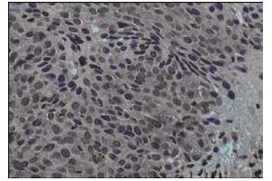 Immunohistochemical staining of human cervical cancer tissue (40X magnification) using  Protein A purified anti-Jagged-1 antibody.