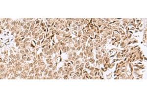 Immunohistochemistry of paraffin-embedded Human ovarian cancer tissue using ELAC1 Polyclonal Antibody at dilution of 1:50(x200)