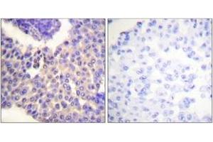 Immunohistochemistry analysis of paraffin-embedded human breast carcinoma, using Arrestin 1 (Phospho-Ser412) Antibody.