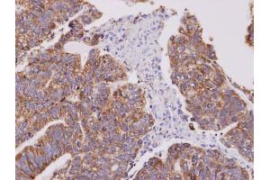IHC-P Image Immunohistochemical analysis of paraffin-embedded human gastric cancer, using Cofilin 2, antibody at 1:100 dilution.
