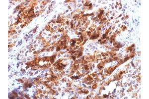 Formalin-fixed, paraffin-embedded human Hepatocellular Carcinoma stained with Glypican-3 Mouse Recombinant Monoclonal Ab (rGPC3/863).