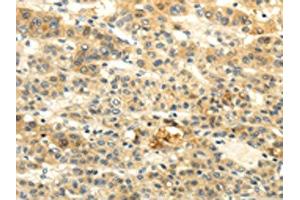 The image on the left is immunohistochemistry of paraffin-embedded Human liver cancer tissue using ABIN7190020(BRWD1 Antibody) at dilution 1/20, on the right is treated with synthetic peptide.