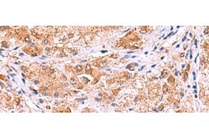 Immunohistochemistry of paraffin-embedded Human liver cancer tissue using UXS1 Polyclonal Antibody at dilution of 1:60(x200)
