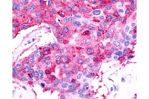Anti-TPRA1 / GPR175 antibody IHC of human Breast, Carcinoma.