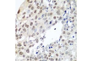 Immunohistochemistry of paraffin-embedded human lung cancer using PTTG1 antibody.