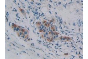 Detection of iPLA2 in Human Pancreatic cancer Tissue using Polyclonal Antibody to Phospholipase A2, Calcium Independent (iPLA2)