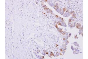 IHC-P Image POR antibody detects POR protein at cytoplasm on human ovarian carcinoma by immunohistochemical analysis.