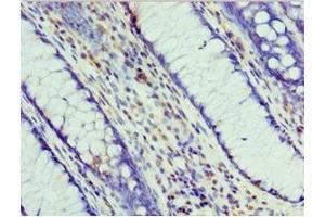 Immunohistochemistry of paraffin-embedded human colon cancer using ABIN7164708 at dilution of 1:100