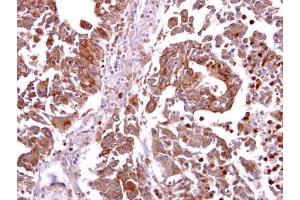 IHC-P Image CCR8 antibody detects CCR8 protein at cytosol and membrane on human hepatoma by immunohistochemical analysis.