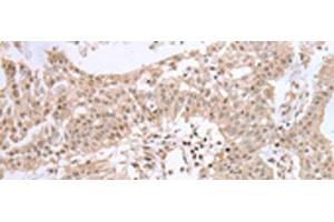 Immunohistochemistry of paraffin-embedded Human colorectal cancer tissue using UBE2I Polyclonal Antibody at dilution of 1:40(x200)
