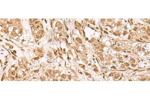 Immunohistochemistry of paraffin-embedded Human breast cancer tissue using BAP1 Polyclonal Antibody at dilution of 1:35(x200)