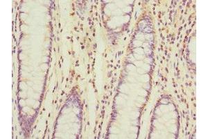 Immunohistochemistry of paraffin-embedded human colon cancer using ABIN7159901 at dilution of 1:100