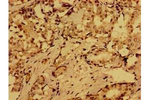 Immunohistochemistry of paraffin-embedded human breast cancer using ABIN7164808 at dilution of 1:100