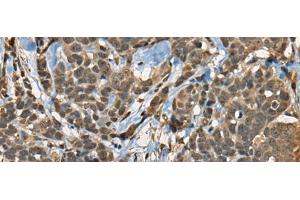 Immunohistochemistry of paraffin-embedded Human thyroid cancer tissue using CIR1 Polyclonal Antibody at dilution of 1:40(x200)