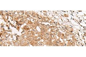 Immunohistochemistry of paraffin-embedded Human breast cancer tissue using GBGT1 Polyclonal Antibody at dilution of 1:40(x200)