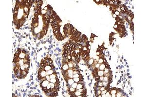 Immunohistochemistry analysis of paraffin-embedded human colon using CK-8 Polyclonal Antibody at dilution of 1:200.