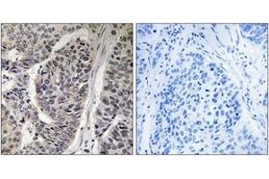 Immunohistochemistry analysis of paraffin-embedded human breast carcinoma, using p130 Cas (Phospho-Tyr410) Antibody.