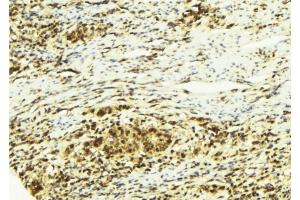 ABIN6278766 at 1/100 staining Human breast cancer tissue by IHC-P.