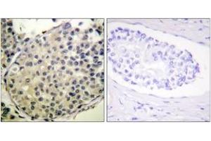 Immunohistochemistry analysis of paraffin-embedded human breast carcinoma, using eIF4G (Phospho-Ser1108) Antibody.