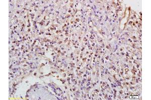 Formalin-fixed and paraffin embedded human gastric carcinoma labeled with Anti-Phospho-PKC gamma (Thr514) Polyclonal Antibody, Unconjugated (ABIN703285) at 1:200 followed by conjugation to the secondary antibody