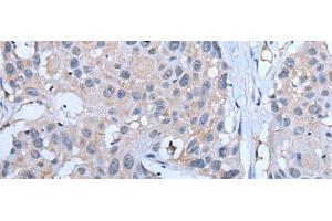 Immunohistochemistry of paraffin-embedded Human esophagus cancer tissue using YPEL5 Polyclonal Antibody at dilution of 1:60(x200)