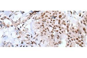 Immunohistochemistry of paraffin-embedded Human liver cancer tissue using XAB2 Polyclonal Antibody at dilution of 1:25(x200)