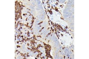 Immunohistochemistry of paraffin-embedded human colon carcinoma using Siglec-15 Rabbit mAb (ABIN7270293) at dilution of 1:100 (40x lens).
