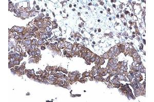 IHC-P Image SQSTM1 antibody [N3C1], Internal detects SQSTM1 protein at cytoplasm on human ovarian carcinoma by immunohistochemical analysis.
