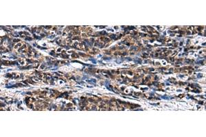 Immunohistochemistry of paraffin-embedded Human prost ate cancer tissue using GANAB Polyclonal Antibody at dilution of 1:30(x200)