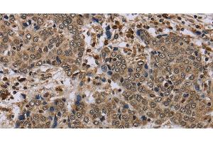 Immunohistochemistry of paraffin-embedded Human liver cancer tissue using NLRP4 Polyclonal Antibody at dilution 1:40
