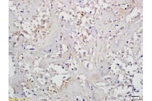 Formalin-fixed and paraffin embedded human gastric cancer labeled with Anti-HIF-1?