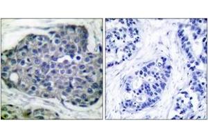 Immunohistochemistry analysis of paraffin-embedded human breast carcinoma, using Acetyl-CoA Carboxylase (Phospho-Ser80) Antibody.