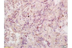 Formalin-fixed and paraffin embedded human lung carcinoma labeled with Anti-RASSF1A Polyclonal Antibody, Unconjugated (ABIN673764) at 1:200 followed by conjugation to the secondary antibody and DAB staining.