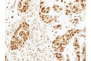 IHC-P Image Immunohistochemical analysis of paraffin-embedded human ovarian cancer, using CENPF, antibody at 1:250 dilution.