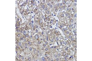 Immunohistochemistry of paraffin-embedded human liver cancer using ZNF259 Rabbit mAb (ABIN1512700, ABIN7101439, ABIN7101440 and ABIN7101441) at dilution of 1:100 (40x lens).