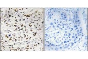Immunohistochemistry analysis of paraffin-embedded human breast carcinoma, using HMG14 (Phospho-Ser21) Antibody.