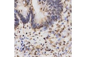 Immunohistochemistry of paraffin-embedded human rectal cancer tissue using H3K27me3 antibody at dilution of 1:200 (x400 lens).
