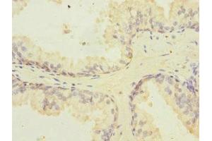 Immunohistochemistry of paraffin-embedded human prostate cancer using ABIN7162859 at dilution of 1:100