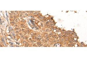 Immunohistochemistry of paraffin-embedded Human ovarian cancer tissue using NRG2 Polyclonal Antibody at dilution of 1:65(x200)