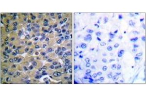 Immunohistochemistry analysis of paraffin-embedded human breast carcinoma, using IkappaB-epsilon (Phospho-Ser22) Antibody.