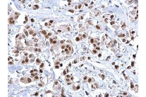 IHC-P Image FOXA1 antibody detects FOXA1 protein at nucleus on human breast carcinoma by immunohistochemical analysis.