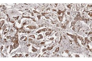 IHC-P Image Immunohistochemical analysis of paraffin-embedded human breast cancer, using Growth Hormone, antibody at 1:100 dilution.
