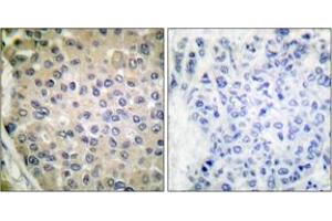 Immunohistochemistry analysis of paraffin-embedded human breast carcinoma, using CPI17 alpha (Phospho-Thr38) Antibody.