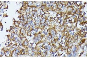 Immunohistochemistry of paraffin-embedded Human esophageal cancer using TBCB Polyclonal Antibody at dilution of 1:100 (40x lens).