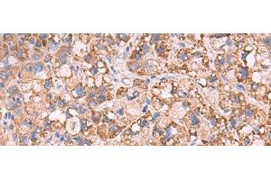 Immunohistochemistry of paraffin-embedded Human liver cancer tissue using KCNN1 Polyclonal Antibody at dilution of 1:55(x200)