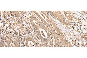Immunohistochemistry of paraffin-embedded Human gastric cancer tissue using FNDC3B Polyclonal Antibody at dilution of 1:45(x200)